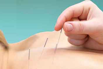 Akupunktur schmerzen
